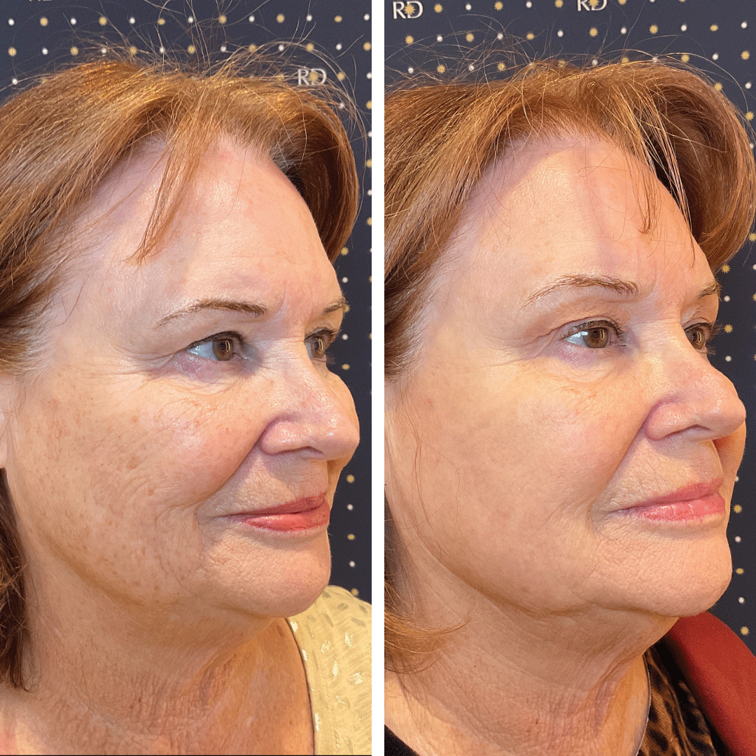 BBL Photofacial treatment significantly reduced the appearance of dark spots on aging sun damaged facial skin.