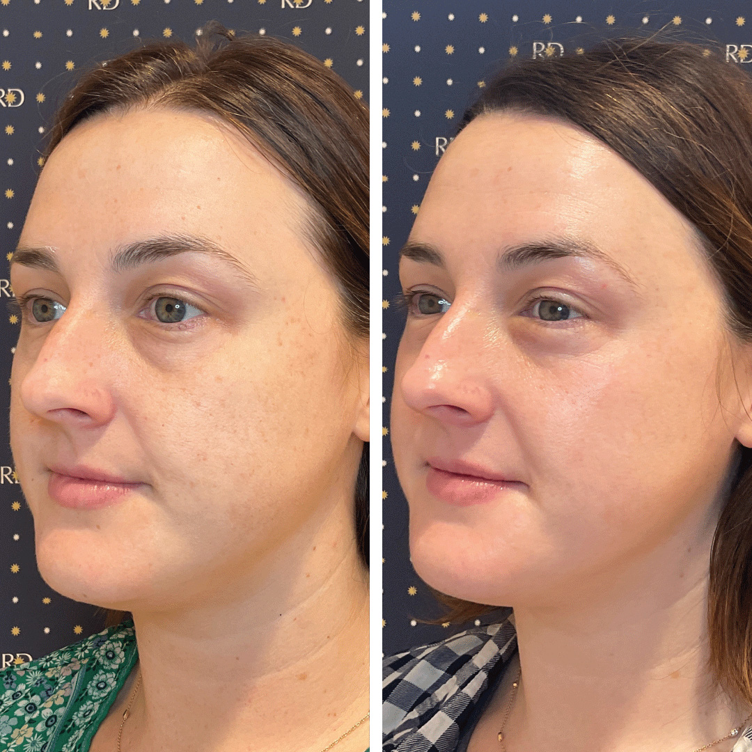 BBL Photofacial treatment resulting in visibly improved facial skin tones on young woman.