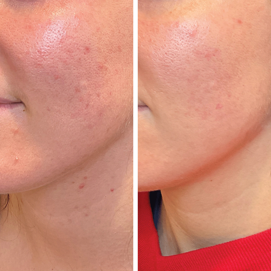 Forever Young BBL treatment at Revival Dermatology shows visibly improved skin along the jawline.