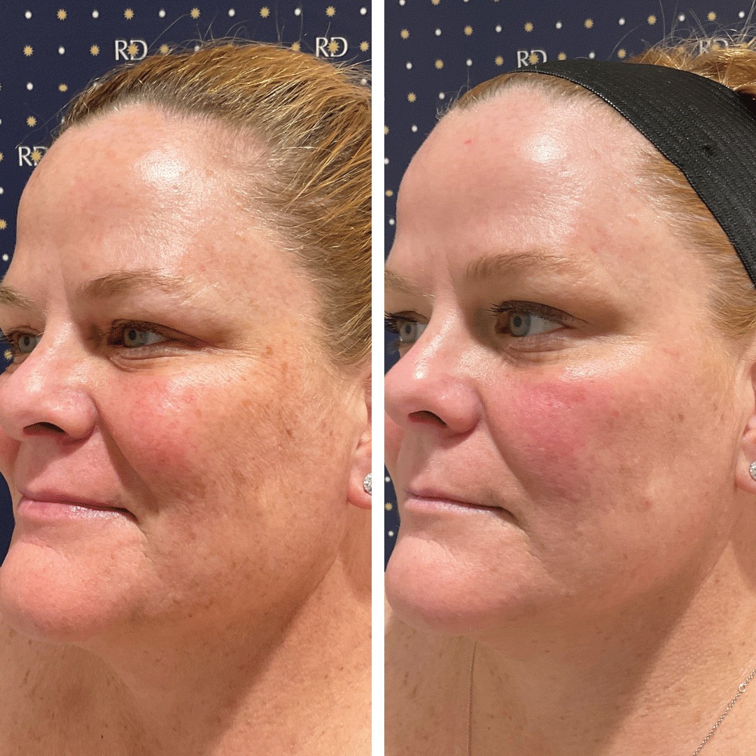 Halo laser treatment and BBL photofacial achieved smoother, more even toned skin on woman's face.