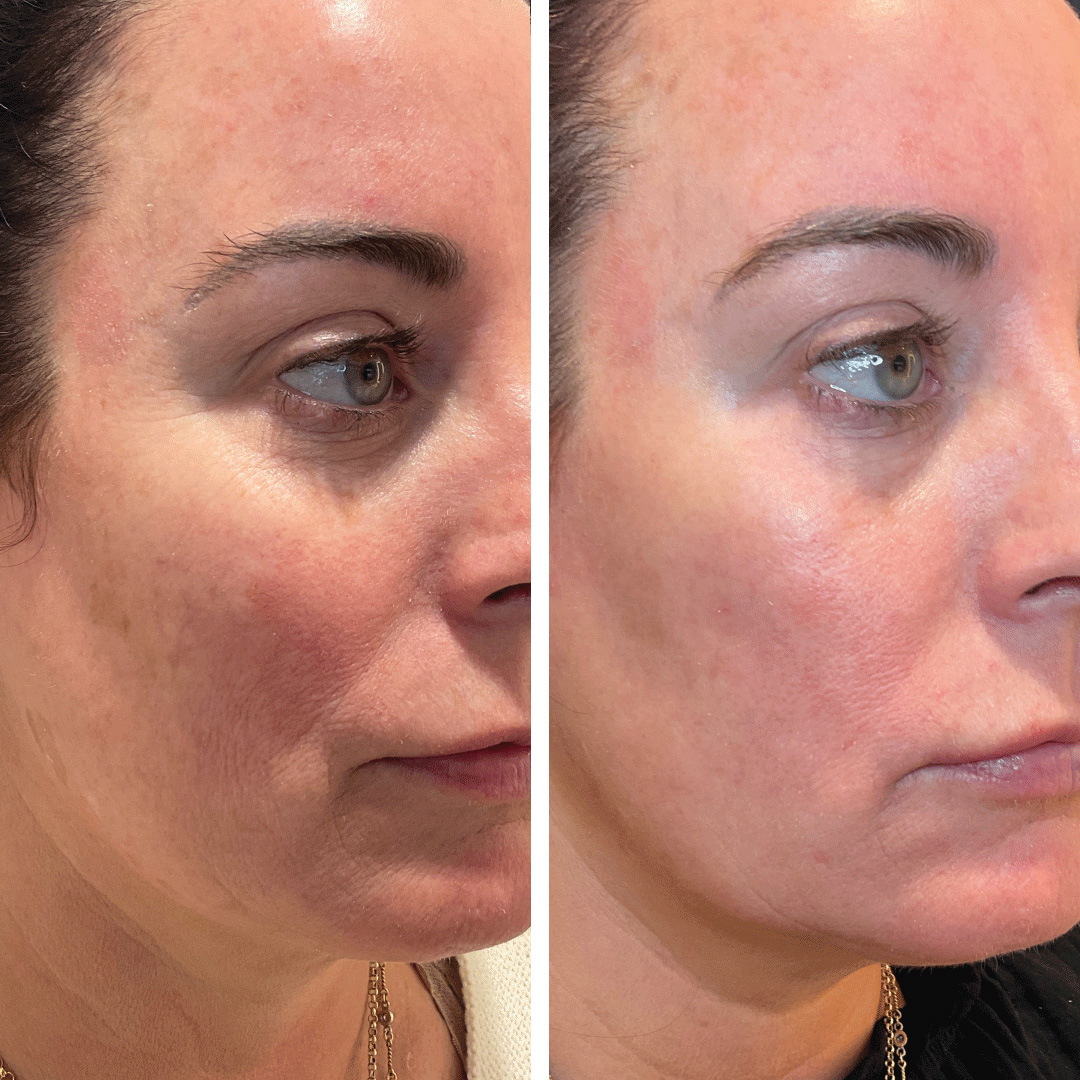 Halo laser treatment results on woman's cheek and laugh lines resulting in visibly smoother skin and lighter dark spots.