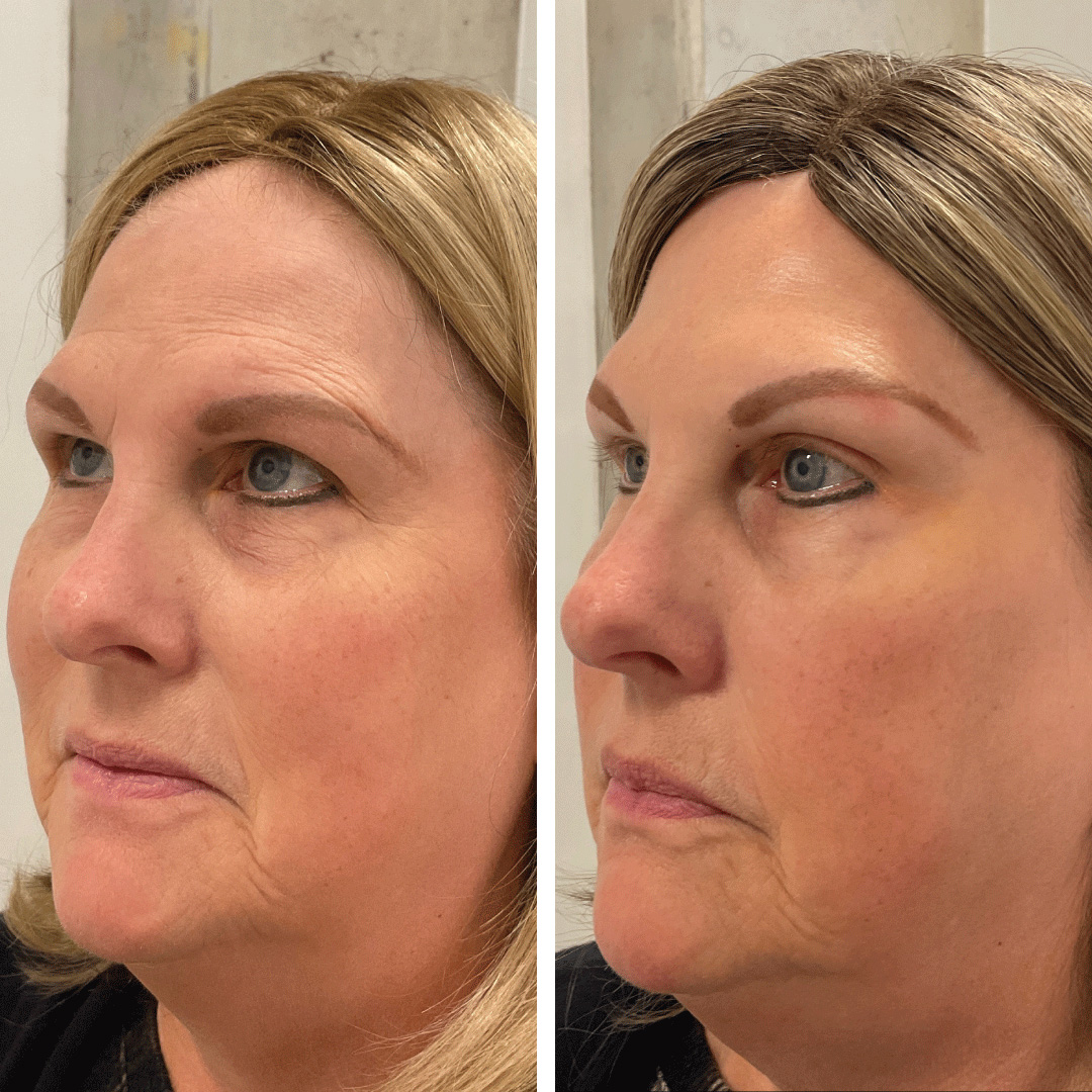 Before and after botox injections on woman's forehead.