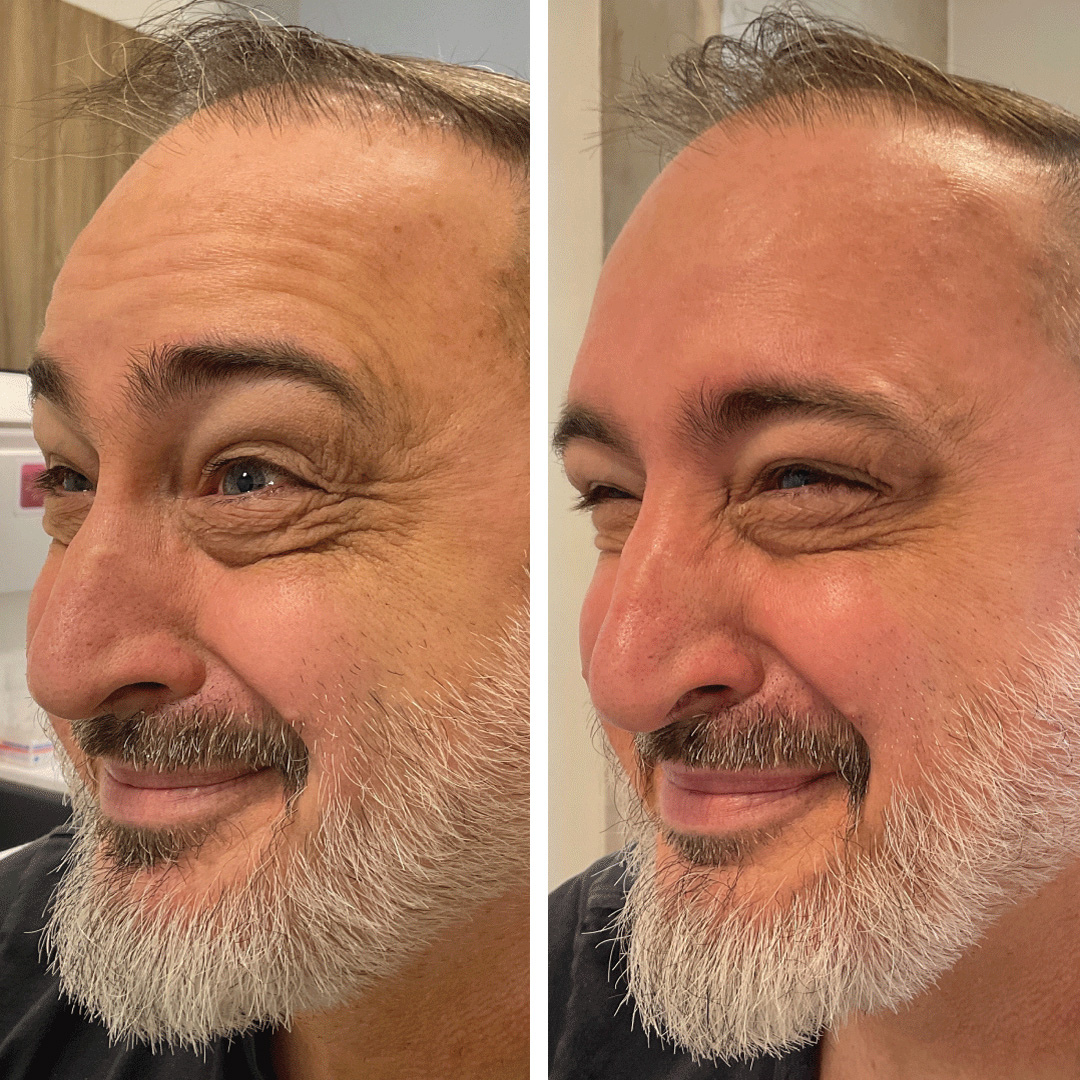 Before and after botox injections on man's forehead and eye are.