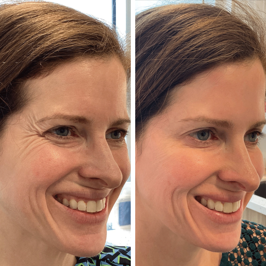 Close up of botox injection results on woman's face, visibly smoother crows feet and forehead.