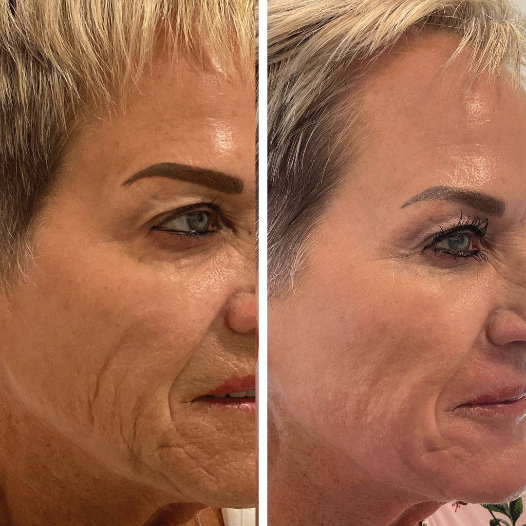Visibly reduced wrinkles on woman's face after Deep Erbium Laser treatment without surgery at Revival Dermatology.