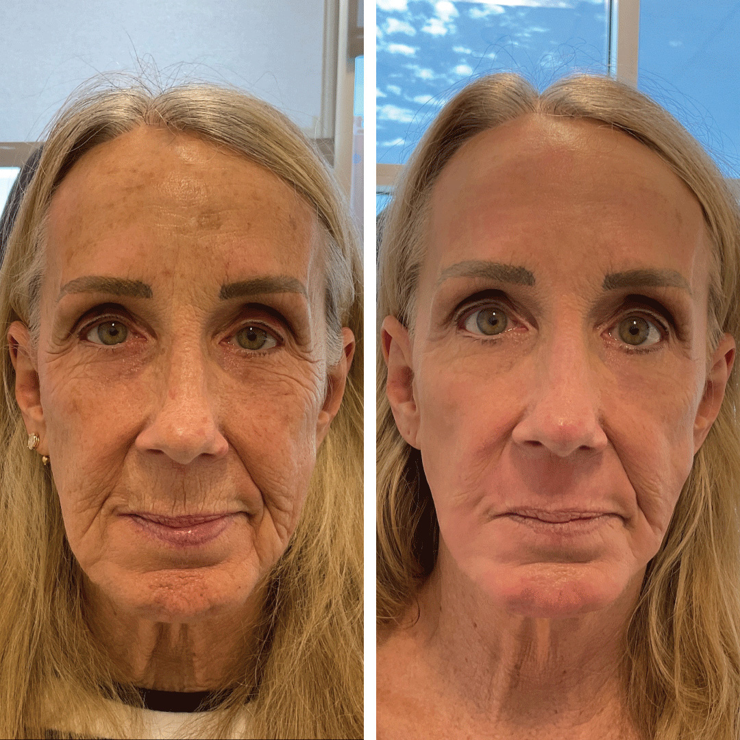 Deep laser resurfacing treatment on woman's face resulting in aggressive wrinkle reduction with 10 days down town performed at Revival Dermatology. reduction possible without surgery. The Erbium can be