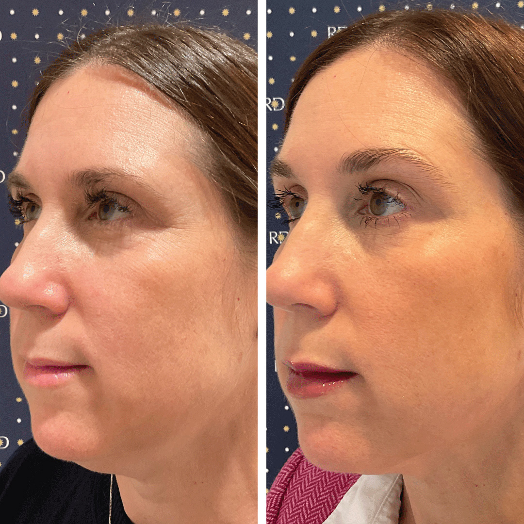 Woman's jawline drastically improved showing tighter skin after receiving Evoke treatment at Revival Dermatology.