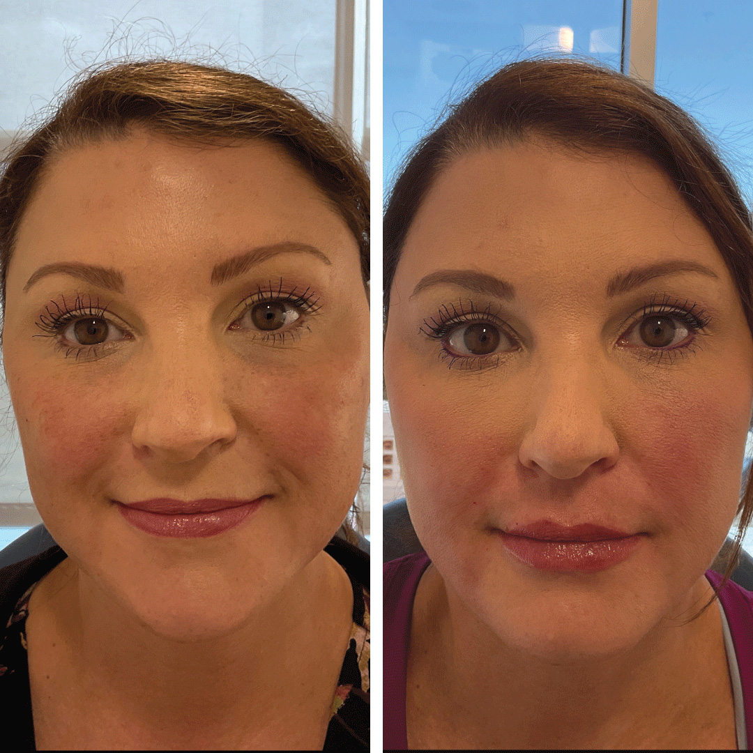 Dermal fillers used to balance facial features, impressive results from Revival Dermatology in Dallas.