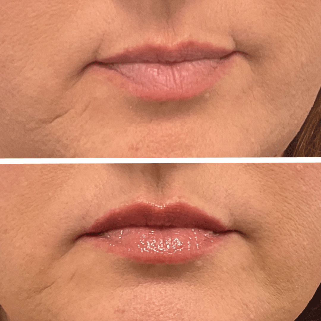 Non-surgical lip filler treatment before and after results.