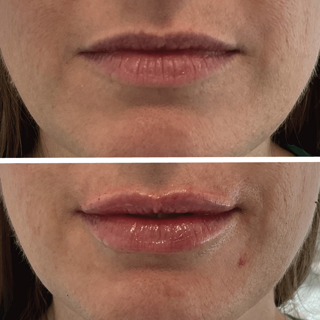 Lip filler treatment before and after images from Revival Dermatology.
