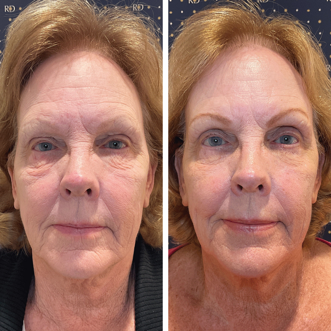 Improved skin quality on woman's face and neck using Morpheus8 at Revival Dermatology.