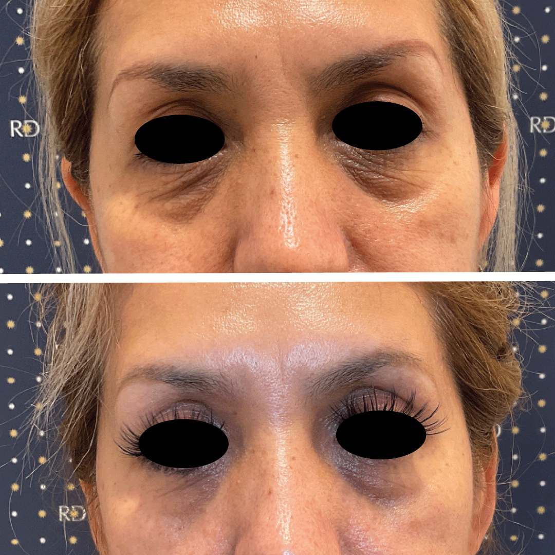 Woman'e eye area Morpheus8 skin tightening treatment showing visible wrinkle reduction.