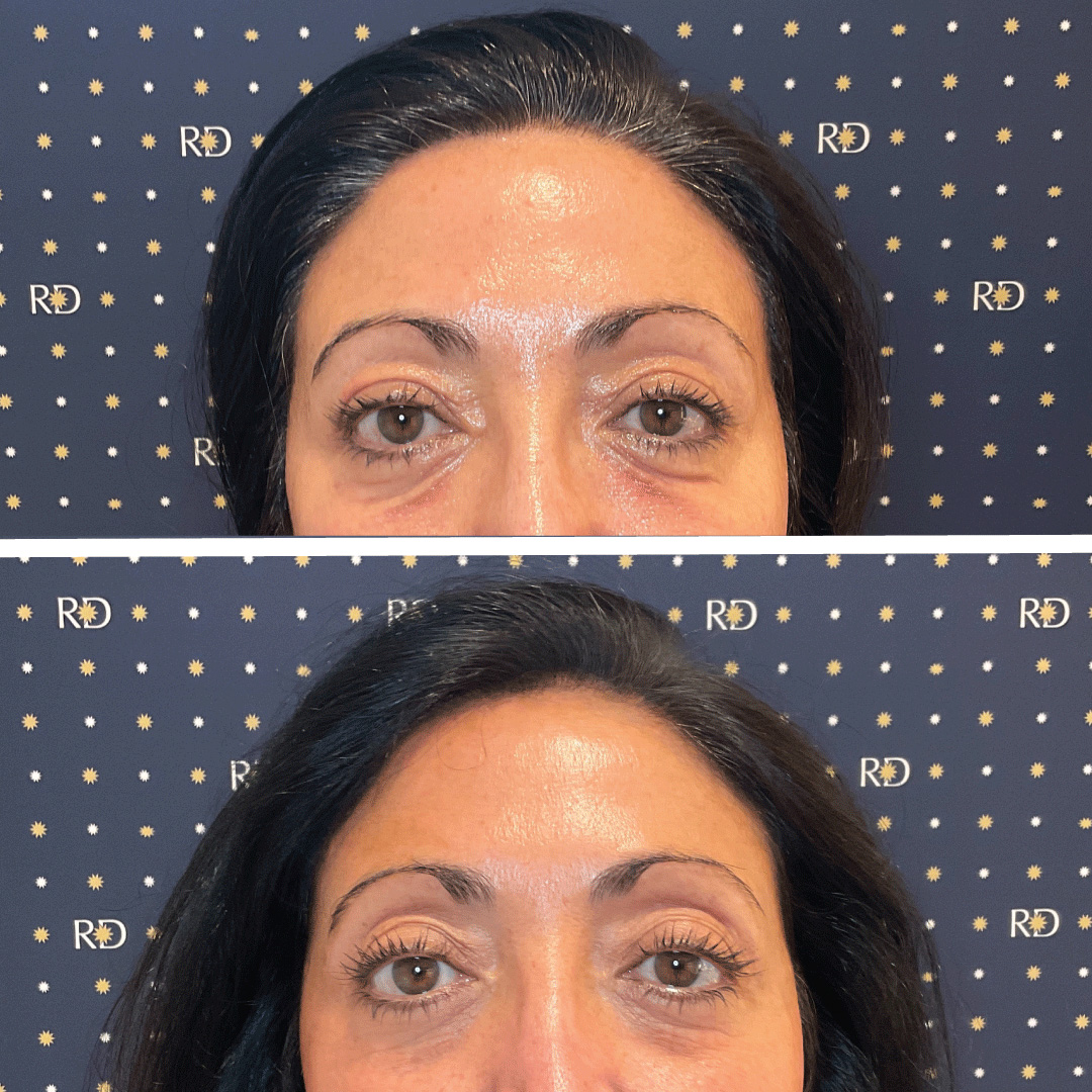 Skin tighten treatment on woman'e under eye area showing visible wrinkle reduction using Morpheus8 radio frequency treatment.