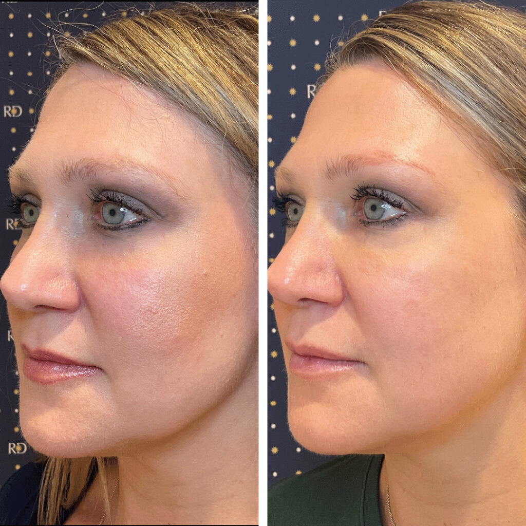 Tightened jawline on woman's face after Evoke facial at Revival Dermatology.