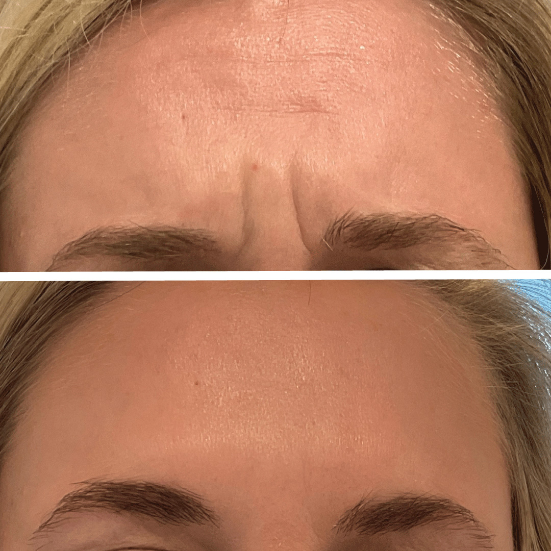 Before and after botox injections on woman's frown lines.