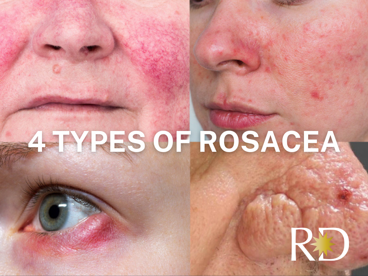 Rosacea: Understanding the Types - Revival Dermatology l Dallas ...