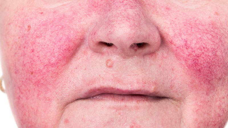Close up frontal view of a woman's cheeks infected with rosacea.