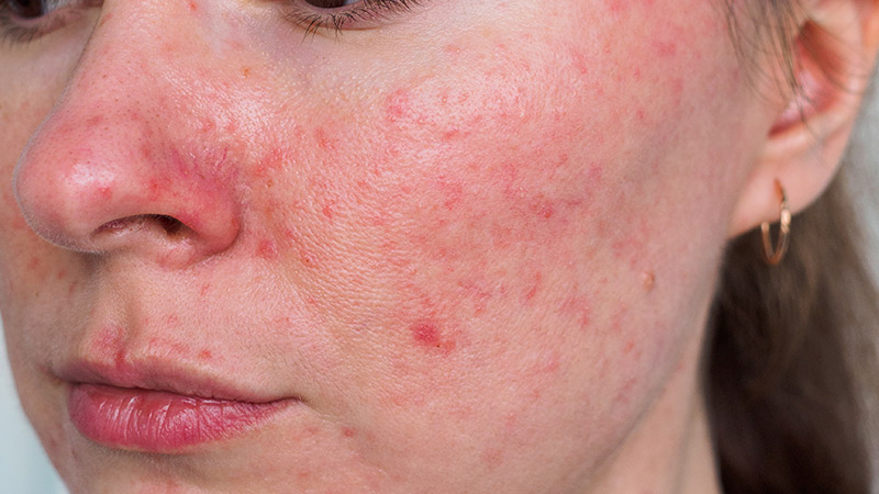 Close up of a young woman's cheek with rosacea redness.