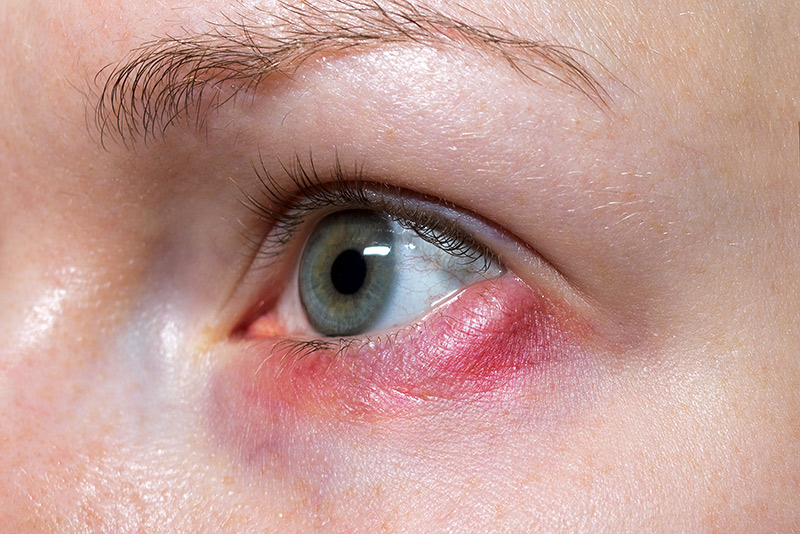 Close up of a women's eye, which is red and puffy with a rosacea infection.