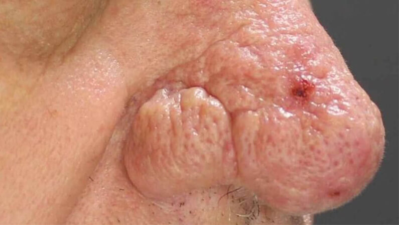 Close up of a man's nose with a skin condition.