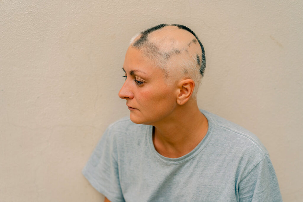 Profile of a Caucasian woman with alopecia areata, visible patches of hair loss.