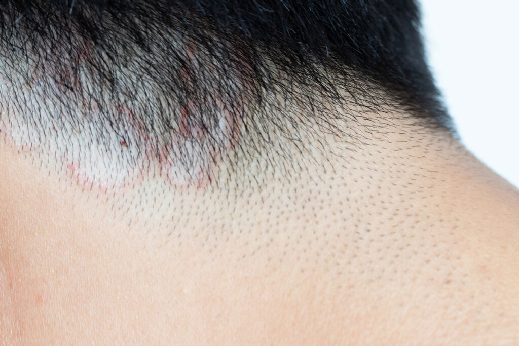 Close up of a mans neck with tinea capitis also known as ringworm of the scalp.