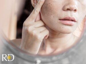 Women looking closely at melasma on her cheek in mirror.