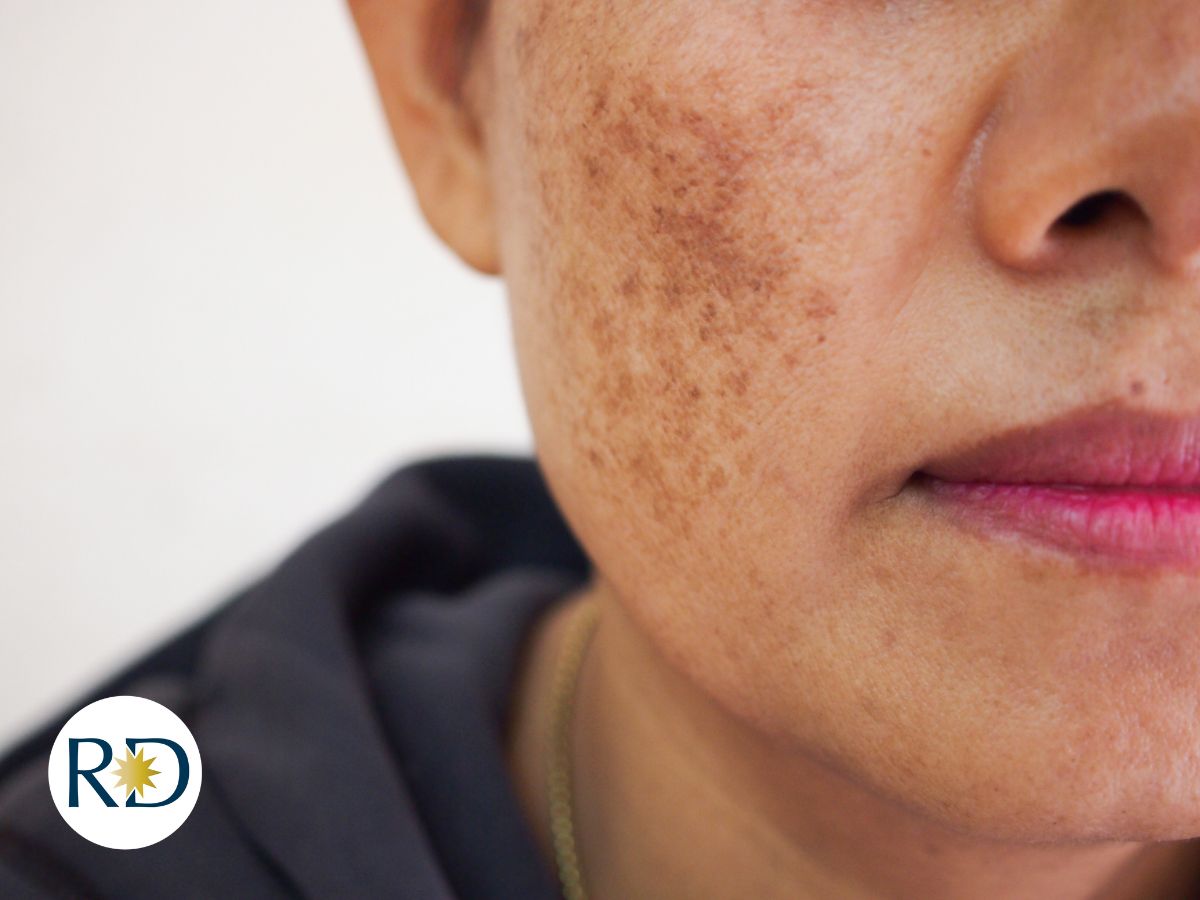 Close-up of melasma on woman's cheek. | Revival Dermatology, Dallas TX