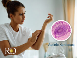 Concerned woman looking at acintic keratoses on her arm.