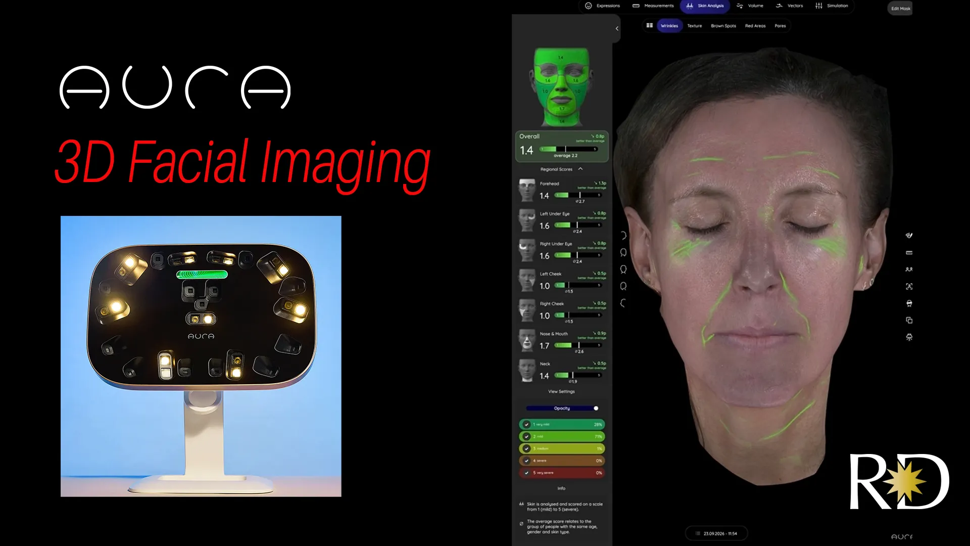 Aura 3D imaging device beside a skin analysis screen mapping wrinkles across a patient’s face, with regional scores.