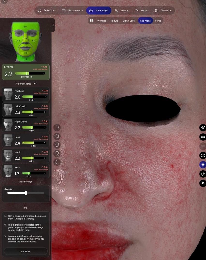 Aura facial skin analysis showing redness and pigmentation